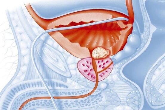 Processus inflammatoire dans la prostate