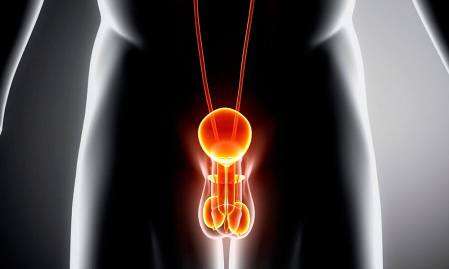 Système génito-urinaire enflammé pour la prostatite