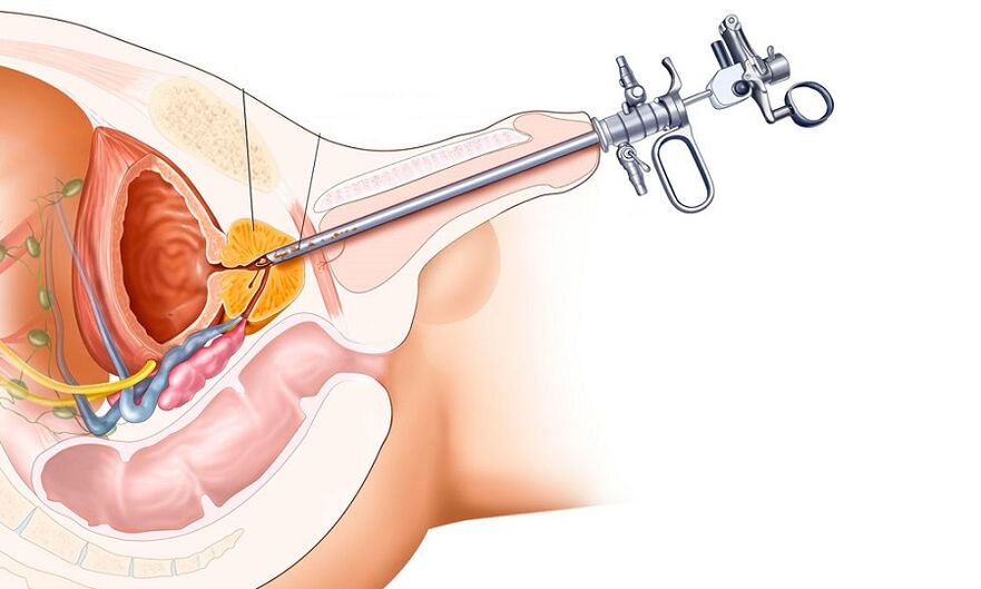Traitement chirurgical de la prostatite