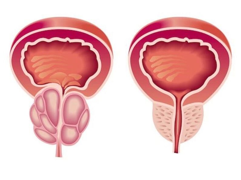 À quoi ressemble la prostatite